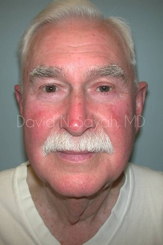 Neck Lift Before and After | simply males