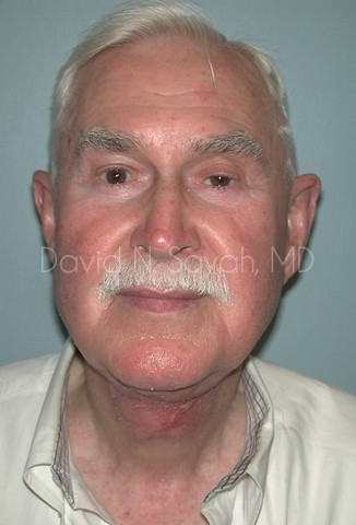 Neck Lift Before and After | simply males