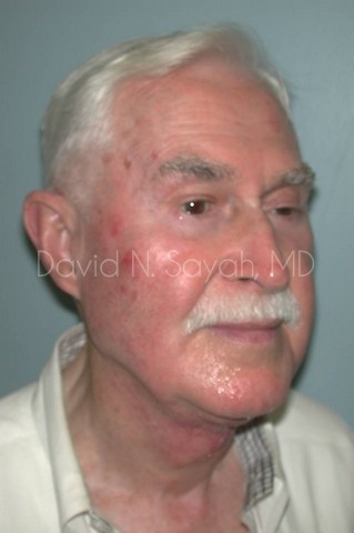 Neck Lift Before and After | simply males