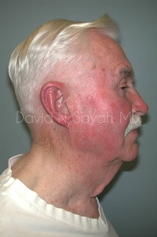 Neck Lift Before and After | simply males