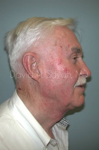 Neck Lift Before and After | simply males