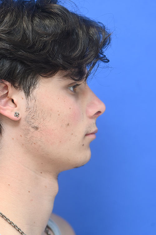 Rhinoplasty Before and After | simply males