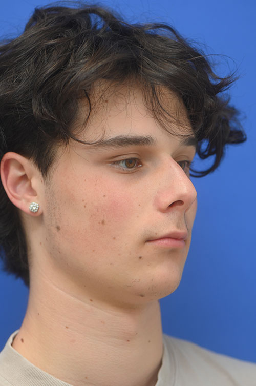 Rhinoplasty Before and After | simply males