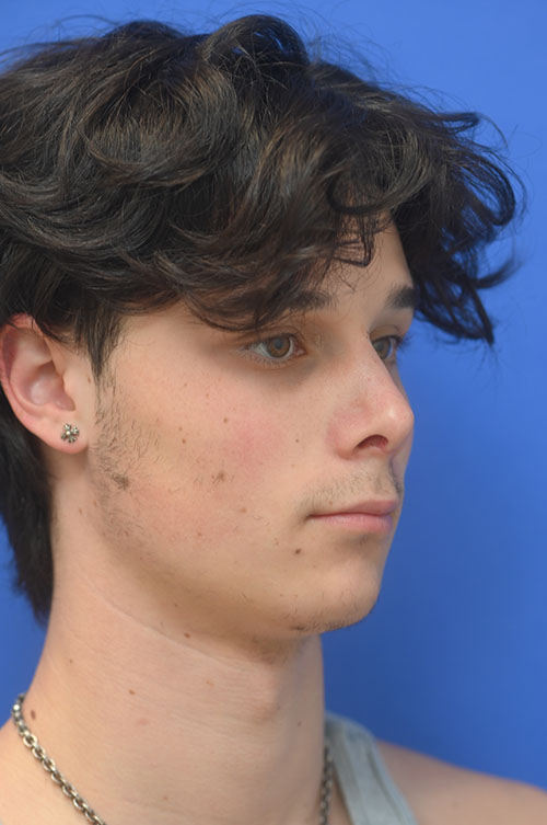 Rhinoplasty Before and After | simply males