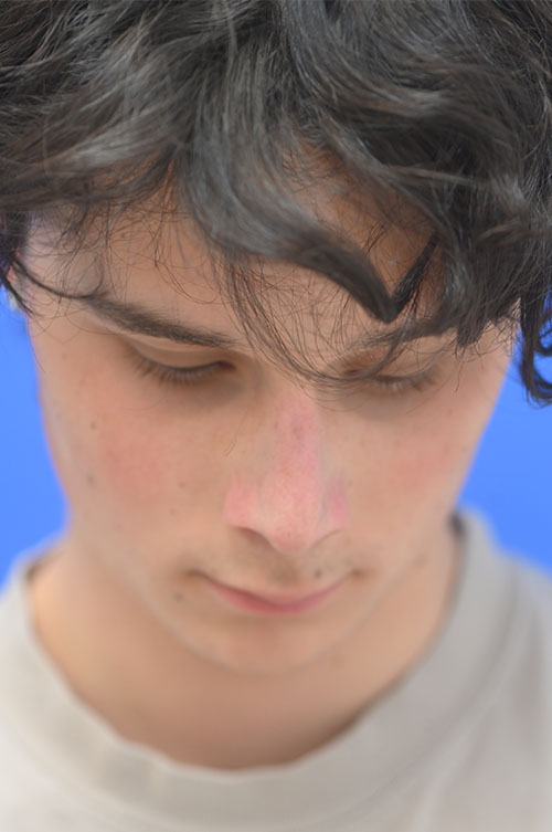 Rhinoplasty Before and After | simply males