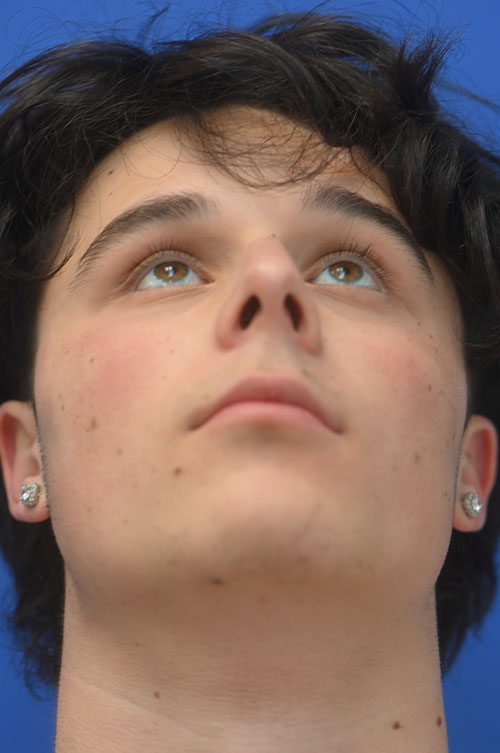 Rhinoplasty Before and After | simply males