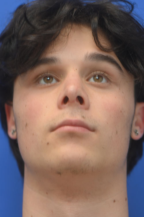 Rhinoplasty Before and After | simply males