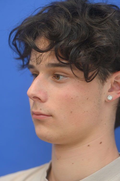 Rhinoplasty Before and After | simply males