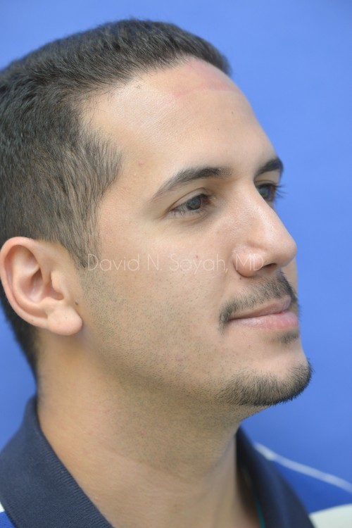 Rhinoplasty Before and After | simply males