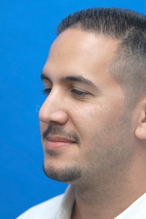 Rhinoplasty Before and After | simply males