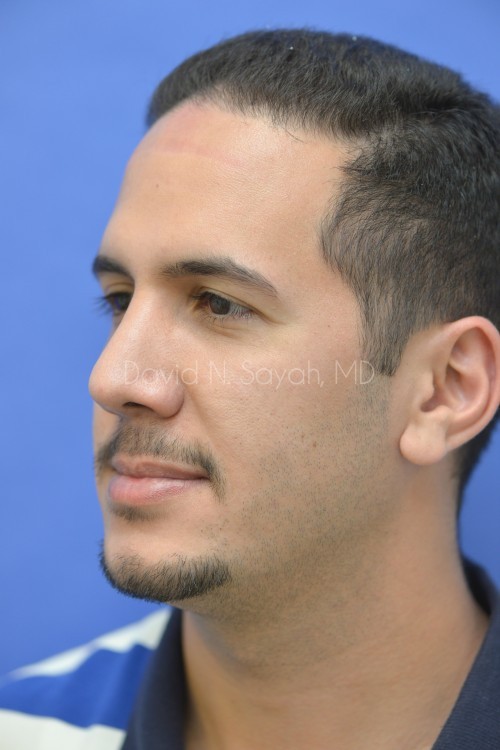 Rhinoplasty Before and After | simply males