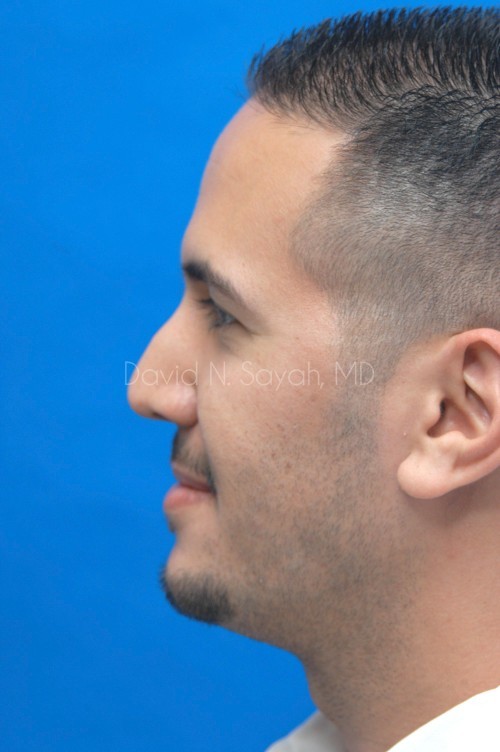 Rhinoplasty Before and After | simply males