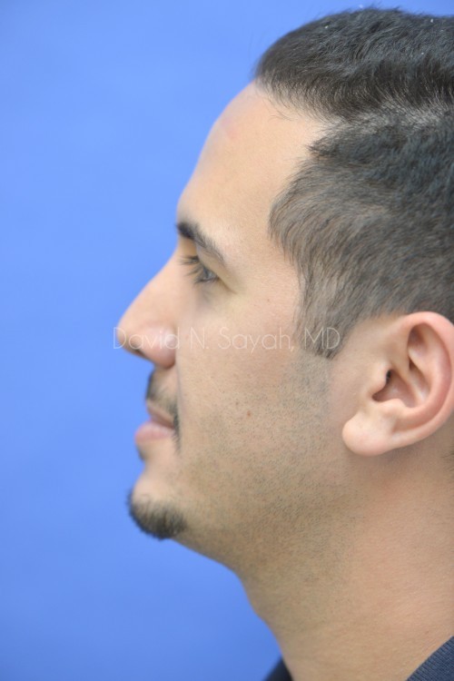 Rhinoplasty Before and After | simply males