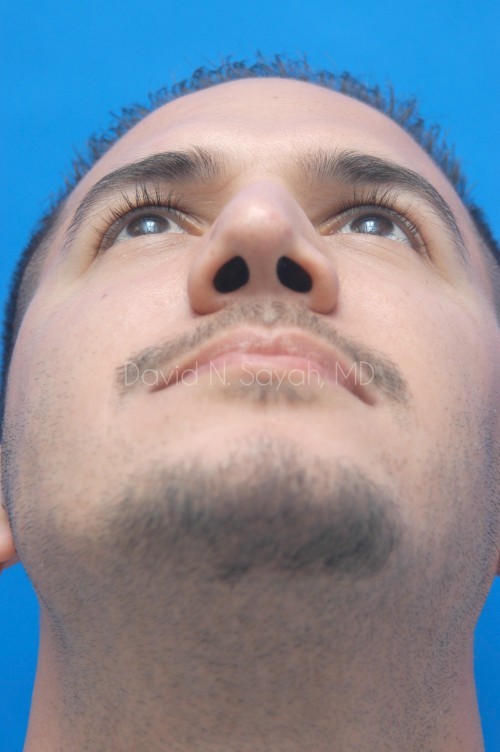 Rhinoplasty Before and After | simply males