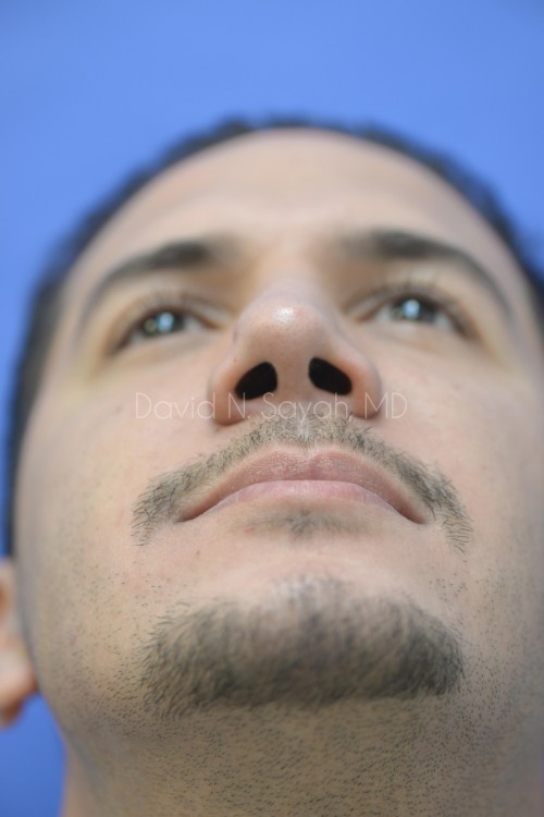 Rhinoplasty Before and After | simply males