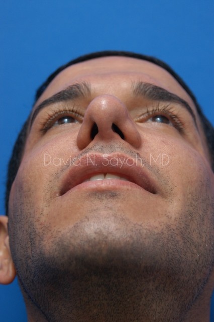 Rhinoplasty Before and After | simply males