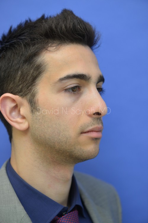 Rhinoplasty Before and After | simply males