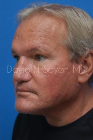 Rhinoplasty Before and After | simply males