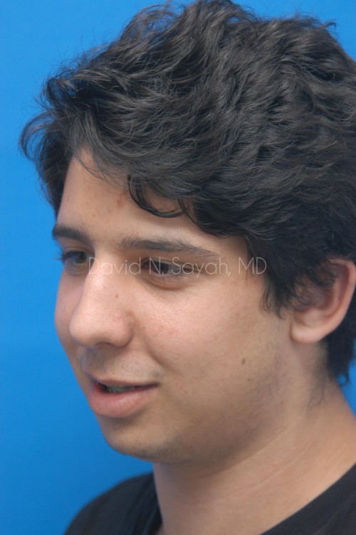 Rhinoplasty Before and After | simply males