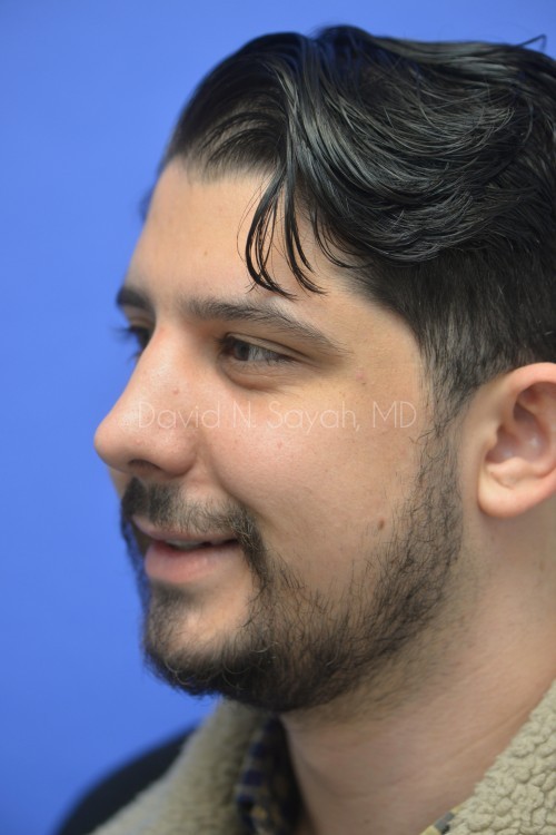 Rhinoplasty Before and After | simply males