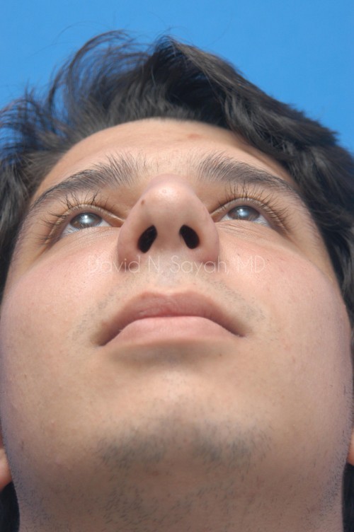 Rhinoplasty Before and After | simply males