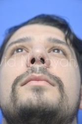 Rhinoplasty Before and After | simply males