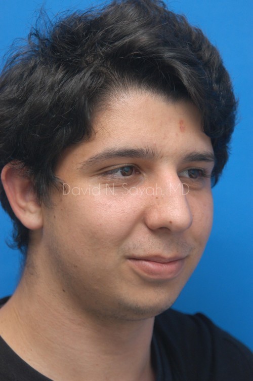 Rhinoplasty Before and After | simply males