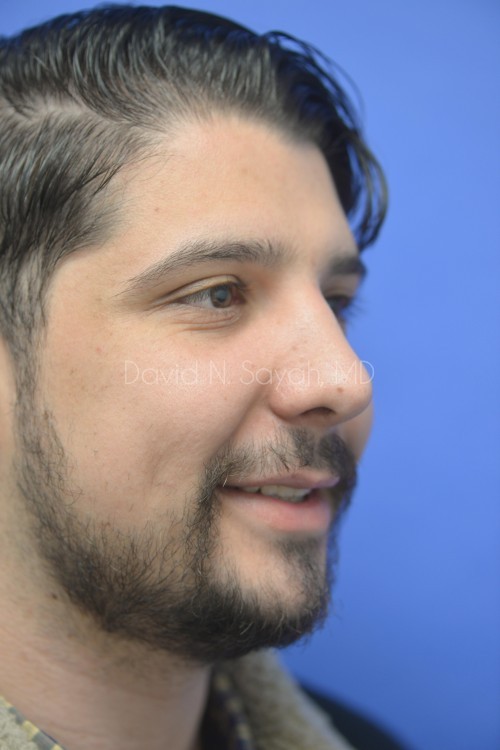 Rhinoplasty Before and After | simply males