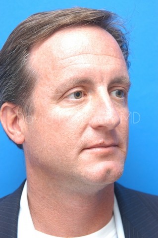 Rhinoplasty Before and After | simply males