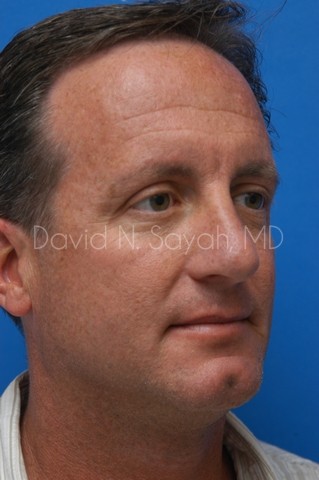 Rhinoplasty Before and After | simply males