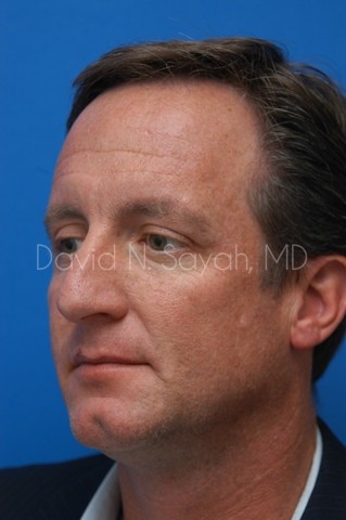 Rhinoplasty Before and After | simply males