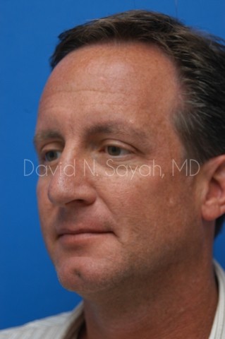 Rhinoplasty Before and After | simply males