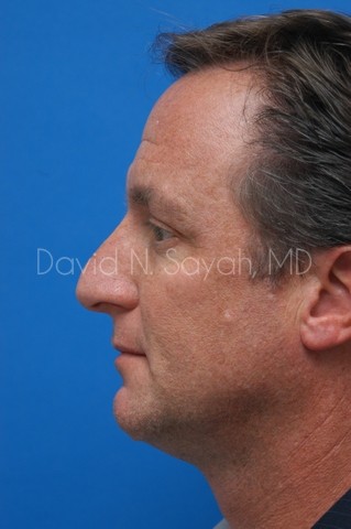 Rhinoplasty Before and After | simply males