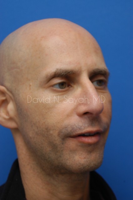 Rhinoplasty Before and After | simply males