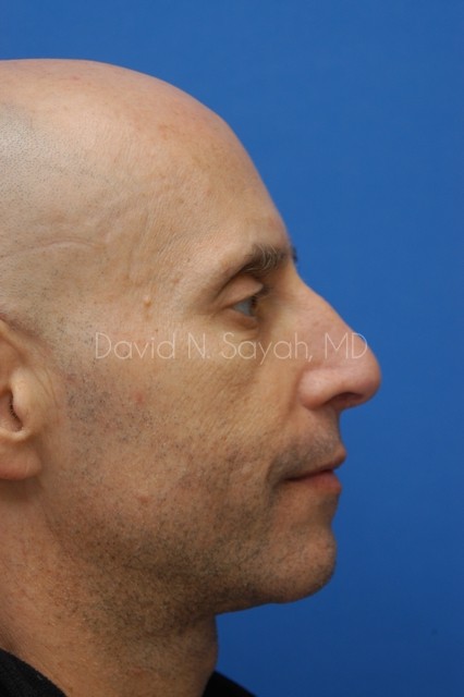 Rhinoplasty Before and After | simply males