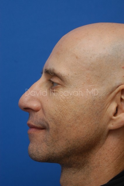 Rhinoplasty Before and After | simply males