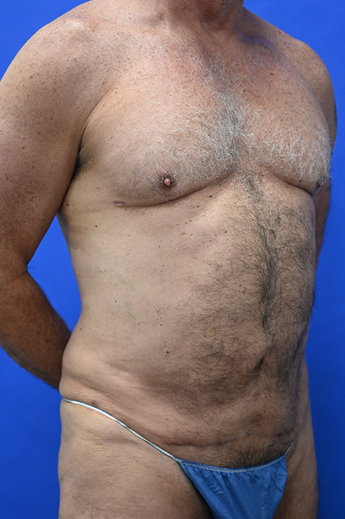 Tummy Tuck Before and After | simply males
