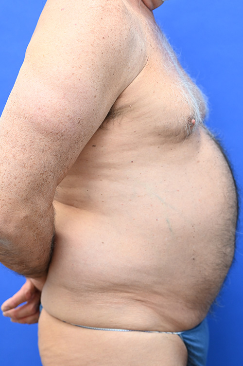 Tummy Tuck Before and After | simply males