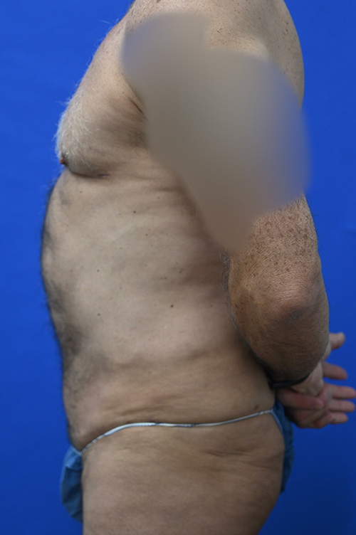 Tummy Tuck Before and After | simply males