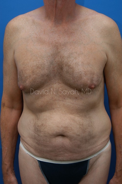 Tummy Tuck Before and After | simply males