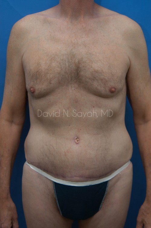 Tummy Tuck Before and After | simply males
