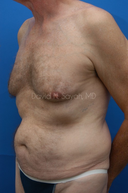 Tummy Tuck Before and After | simply males