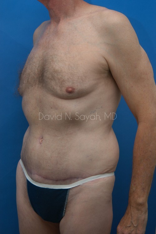 Tummy Tuck Before and After | simply males