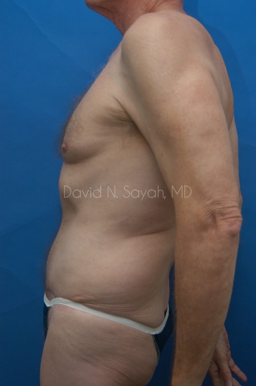 Tummy Tuck Before and After | simply males