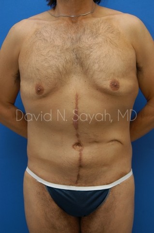 Tummy Tuck Before and After | simply males