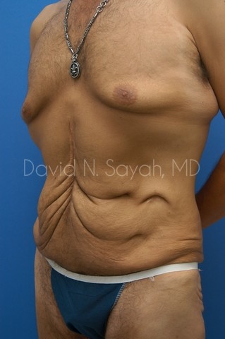 Tummy Tuck Before and After | simply males