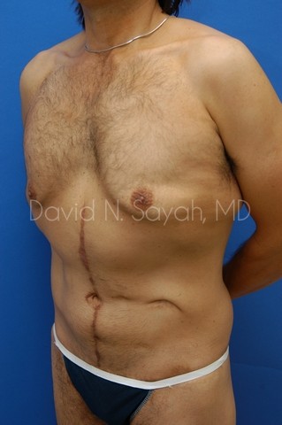 Tummy Tuck Before and After | simply males