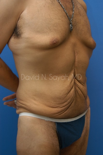 Tummy Tuck Before and After | simply males