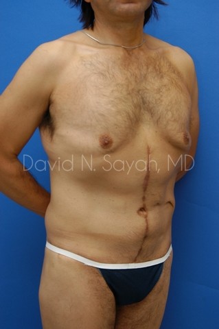 Tummy Tuck Before and After | simply males