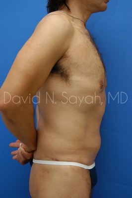 Tummy Tuck Before and After | simply males